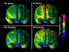 Sự khác nhau giữa não bình thường và não bị tâm thần phân liệt ở nam và nữ (Trái: não thường, phải: não bị tâm thần phân liệt, trên: não của nam giới, dưới: não của nữ giới)